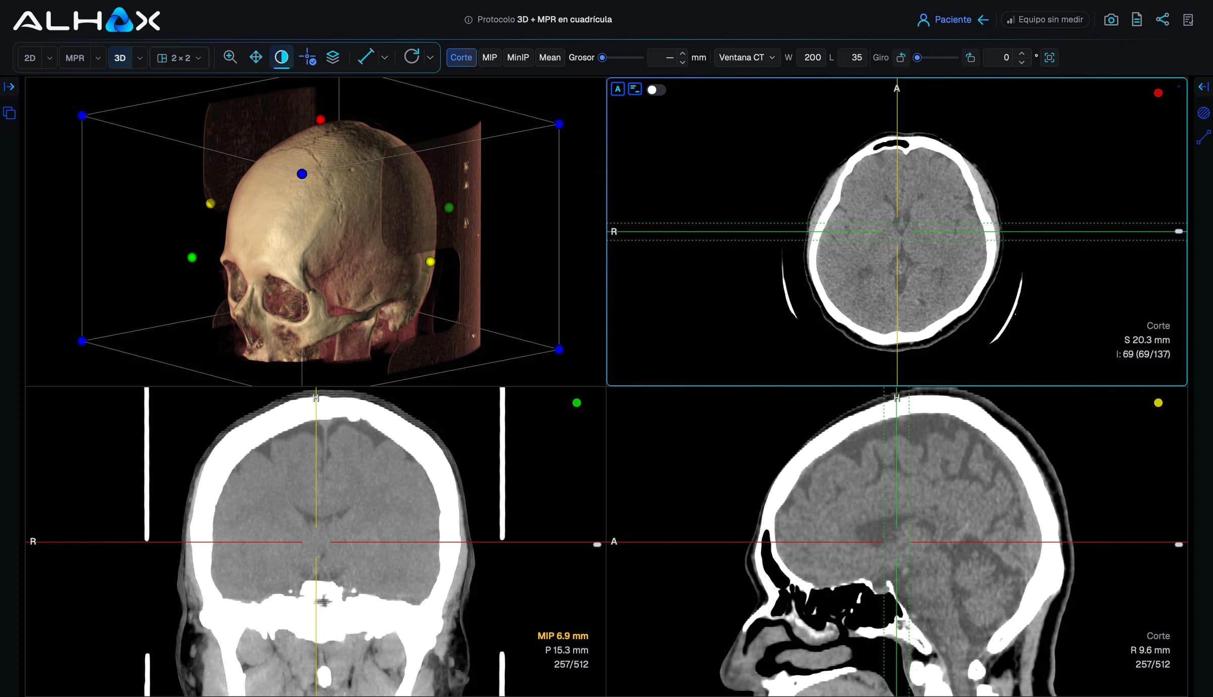 Visor de ALHAX en el navegador con una tomografía de cerebro en cuadrícula de 2×2: reconstrucción tridimensional del cráneo y los cortes axial, coronal y sagital sincronizados.